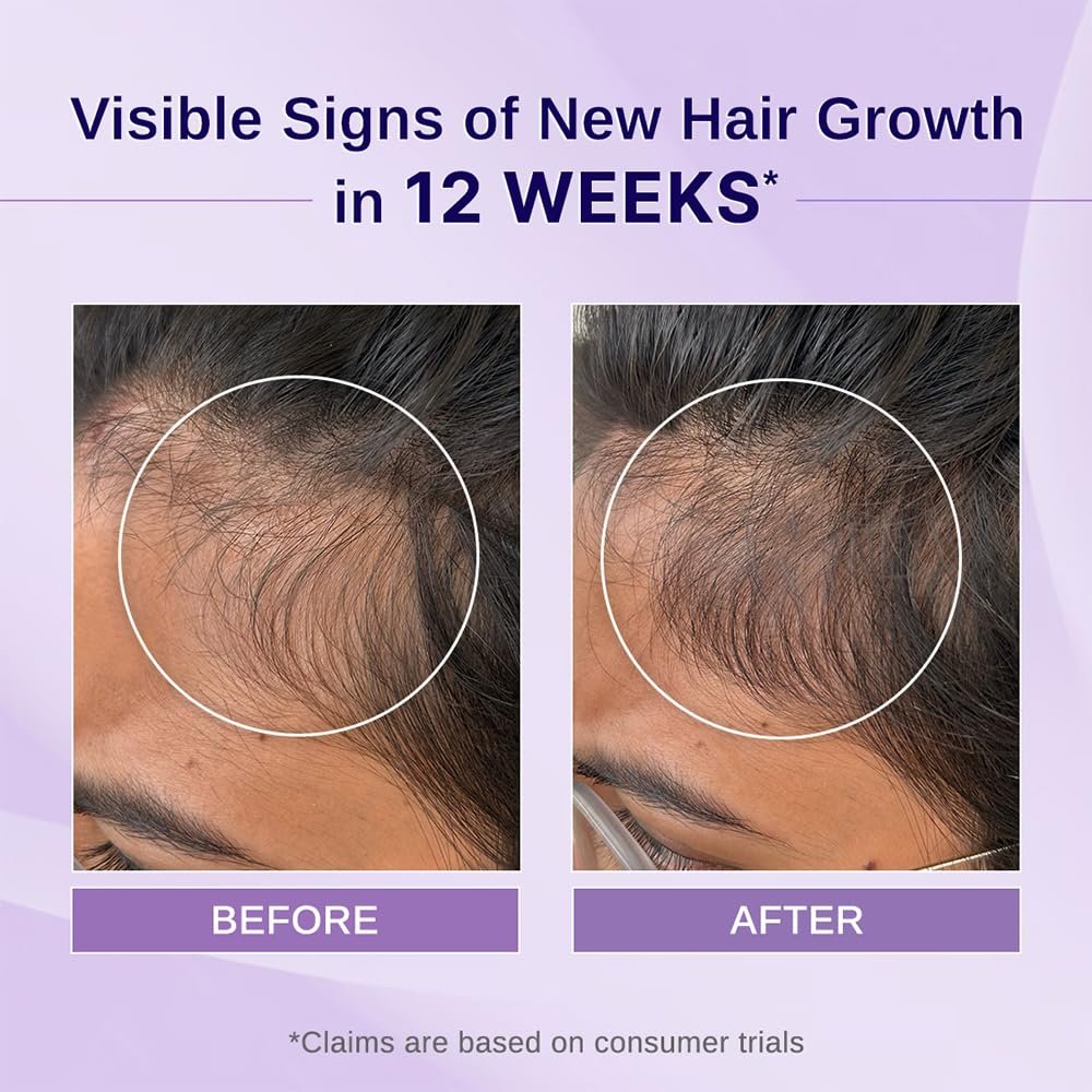 Bare Anatomy Nature x Science Rosemary Hibiscus Hair Growth Oil for Women & Men - Helps Hair Growth & Strengthens Hair, Nourishes Scalp & Controls Hair Fall, Suitable for All Hair Types - 100ml - görsel 3