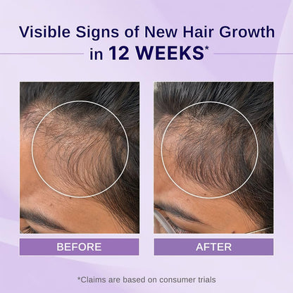 Bare Anatomy Nature x Science Rosemary Hibiscus Hair Growth Oil for Women & Men - Helps Hair Growth & Strengthens Hair, Nourishes Scalp & Controls Hair Fall, Suitable for All Hair Types - 100ml