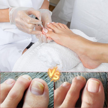 2-Pack Ingrown Toenail Drops & Relief Kit with Silicone Gel Toe Caps | AUJ Avelisse