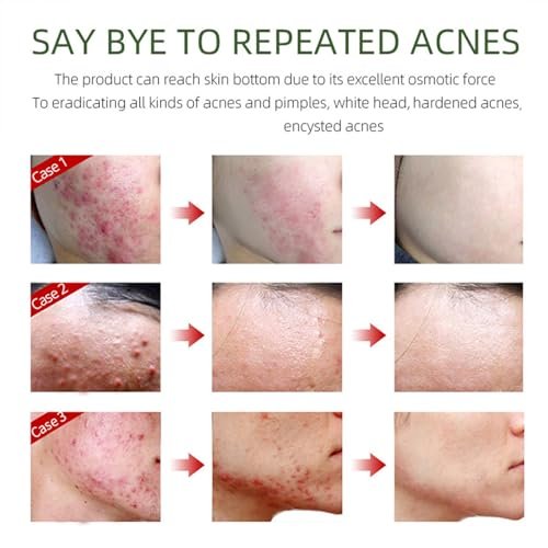 Acne Removing Face Cream - Natural Ingredients for Teens & Adults - Anti-Acne Moisturizer Pimple Cream by Grospe - görsel 10
