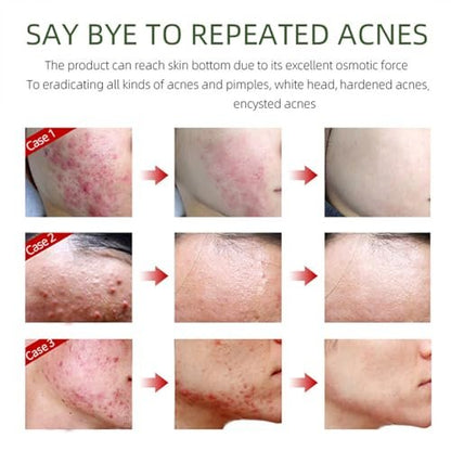 Acne Removing Face Cream - Natural Ingredients for Teens & Adults - Anti-Acne Moisturizer Pimple Cream by Grospe