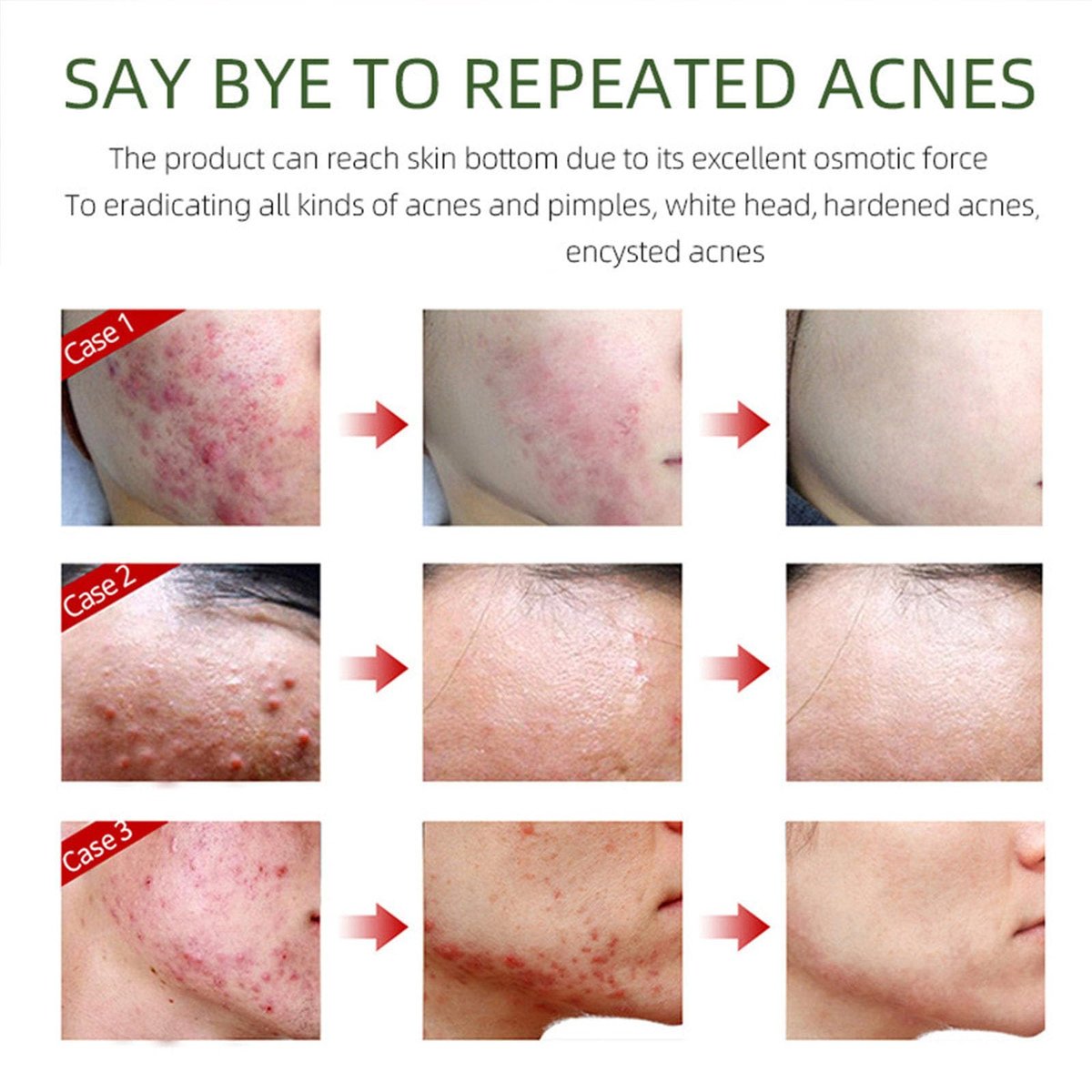 Acne Removing Face Cream - Natural Ingredients for Teens & Adults - Anti-Acne Moisturizer Pimple Cream by Grospe - görsel 9