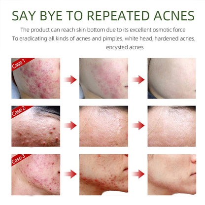 Acne Removing Face Cream - Natural Ingredients for Teens & Adults - Anti-Acne Moisturizer Pimple Cream by Grospe