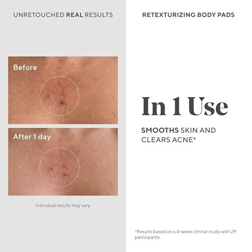 Murad Retexturizing Body Pads – Acne-Fighting Exfoliating Pads with Azelaic, Salicylic, and Glycolic Acid for Acne Breakouts, Smoothing KP Bumps, and Soothing Aggravated Skin – 45 Pads Avelisse