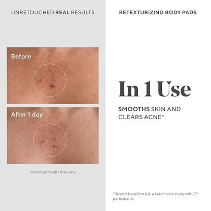 Murad Retexturizing Body Pads – Acne-Fighting Exfoliating Pads with Azelaic, Salicylic, and Glycolic Acid for Acne Breakouts, Smoothing KP Bumps, and Soothing Aggravated Skin – 45 Pads Avelisse