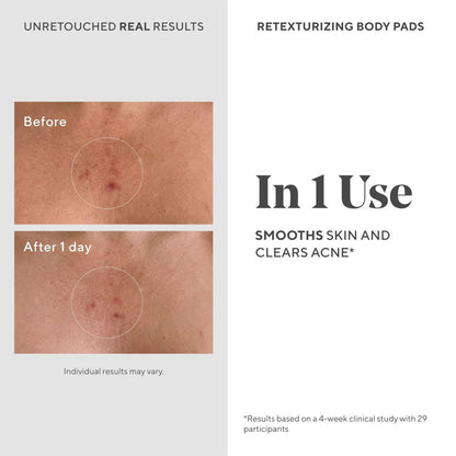 Murad Retexturizing Body Pads – Acne-Fighting Exfoliating Pads with Azelaic, Salicylic, and Glycolic Acid for Acne Breakouts, Smoothing KP Bumps, and Soothing Aggravated Skin – 45 Pads Avelisse