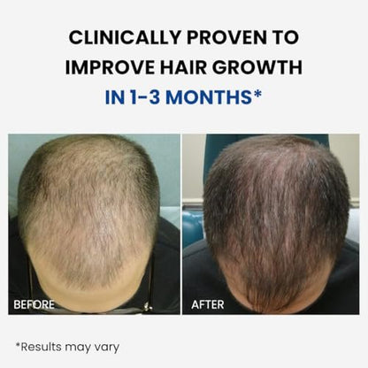 ForHair Men Hair Growth Spray – Stimulates New Hair, Strengthens Follicles – Local Regrowth Action, No Unwanted Body Hair – Safe and Easy Alternative to Pills, Costly and Painful Treatments Avelisse