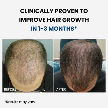 ForHair Men Hair Growth Spray – Stimulates New Hair, Strengthens Follicles – Local Regrowth Action, No Unwanted Body Hair – Safe and Easy Alternative to Pills, Costly and Painful Treatments Avelisse