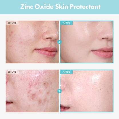 TOSOWOONG Zinc Oxide 10 Cream - 100,000ppm Zinc Oxide for Acne, Redness, Rosacea, Skin Barrier Repair, Moisturizing, Non-Comedogenic Korean Skincare, 50g/1.76 oz Avelisse