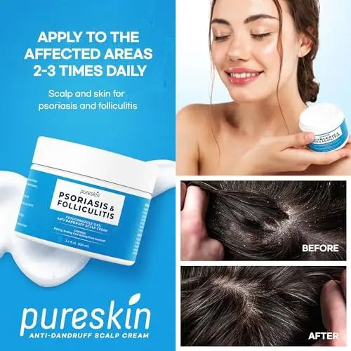 PURESKIN Scalp Cream for Psoriasis & Folliculitis – Herbal Relief for Itching & Flaking, 3.4 Oz Avelisse