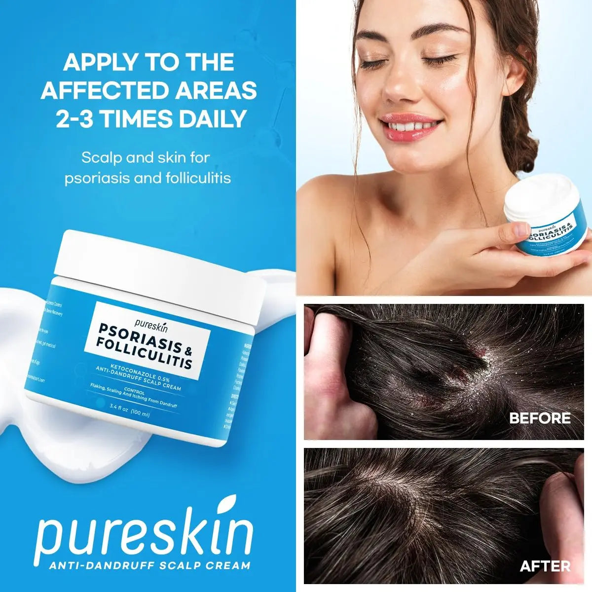 PURESKIN Scalp Cream for Psoriasis & Folliculitis – Herbal Relief for Itching & Flaking, 3.4 Oz Avelisse