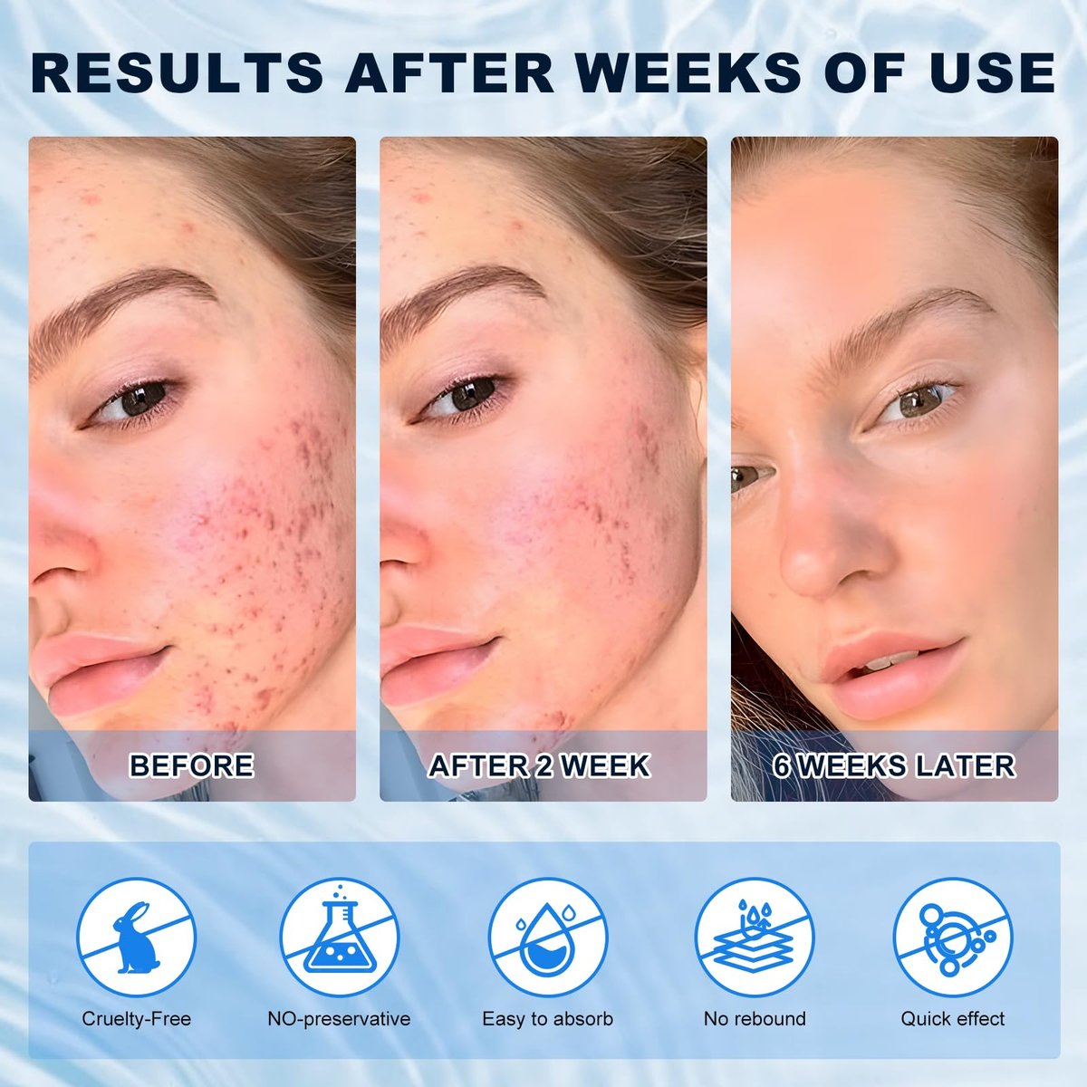 Azelaic Acid 10% Cream for Face – Acne & Rosacea Relief, Reduces Pimples, Blackheads, Pigmentation & Redness - görsel 7