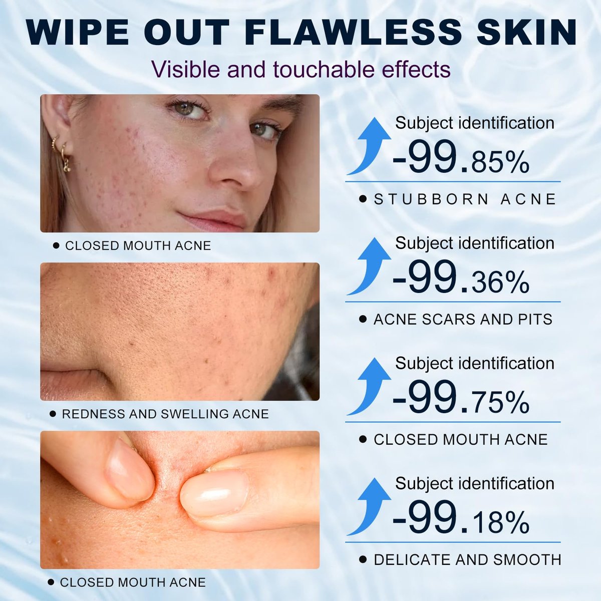 Azelaic Acid 10% Cream for Face – Acne & Rosacea Relief, Reduces Pimples, Blackheads, Pigmentation & Redness - görsel 11