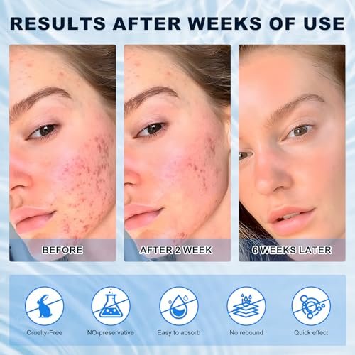 Azelaic Acid 10% Cream for Face – Acne & Rosacea Relief, Reduces Pimples, Blackheads, Pigmentation & Redness - görsel 8