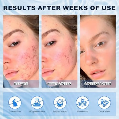 Azelaic Acid 10% Cream for Face – Acne & Rosacea Relief, Reduces Pimples, Blackheads, Pigmentation & Redness