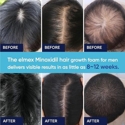 5% Minoxidil Foam for Men and Women – Hair Regrowth Treatment (60ml)