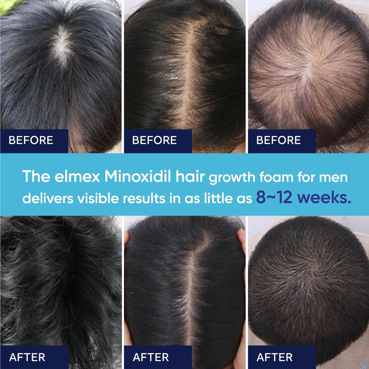 5% Minoxidil Foam for Men and Women – Hair Regrowth Treatment (60ml) - görsel 10