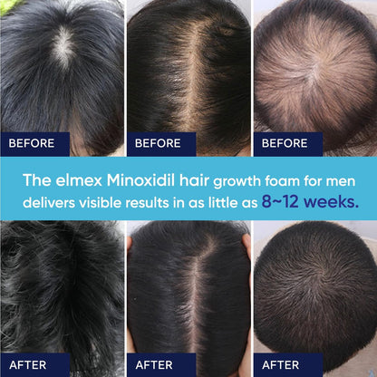 5% Minoxidil Foam for Men and Women – Hair Regrowth Treatment (60ml)