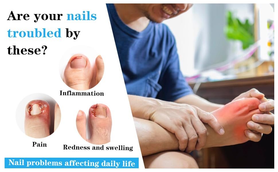 Ingrown Toenail Treatment Corrector Set (50+1 Pcs) – Professional Pain-Free Removal Kit with Lifter & Strips for Men & Women Avelisse