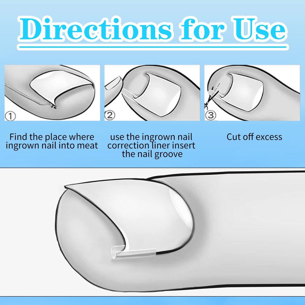 Ingrown Toenail Treatment Corrector Set (50+1 Pcs) – Professional Pain-Free Removal Kit with Lifter & Strips for Men & Women Avelisse