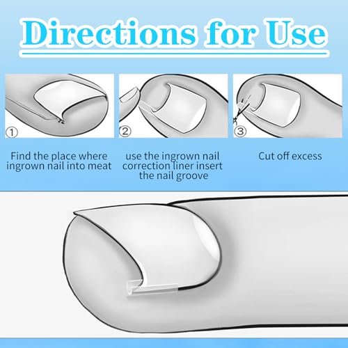 Ingrown Toenail Treatment Corrector Set (50+1 Pcs) – Professional Pain-Free Removal Kit with Lifter & Strips for Men & Women Avelisse