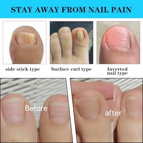 Ingrown Toenail Treatment Corrector Set (50+1 Pcs) – Professional Pain-Free Removal Kit with Lifter & Strips for Men & Women Avelisse