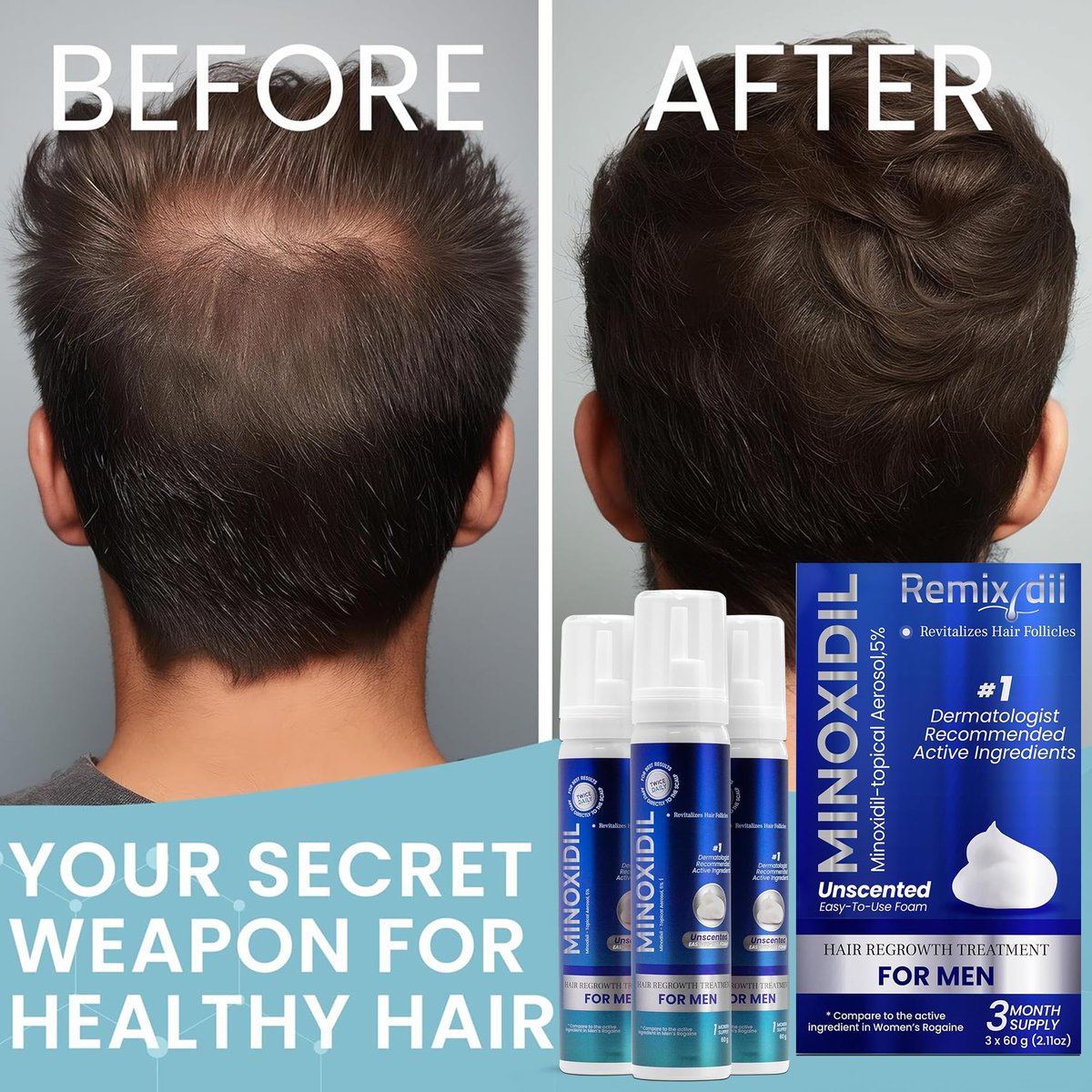 Remixidil Men's 5% Minoxidil Foam – Clinically Proven Hair Regrowth Treatment, 3-Month Supply, No Scalp Irritation Avelisse