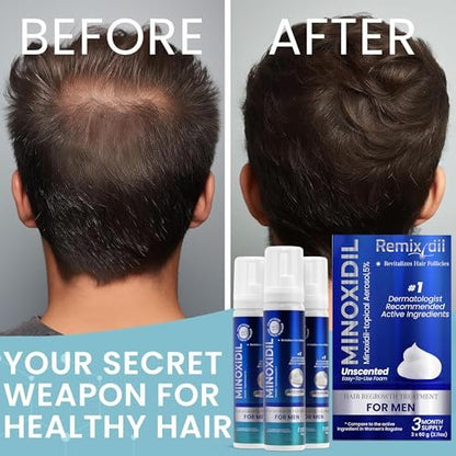 Remixidil Men's 5% Minoxidil Foam – Clinically Proven Hair Regrowth Treatment, 3-Month Supply, No Scalp Irritation Avelisse