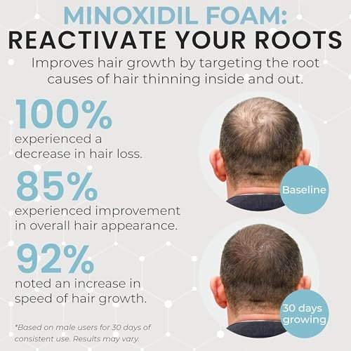 Remixidil Men's 5% Minoxidil Foam – Clinically Proven Hair Regrowth Treatment, 3-Month Supply, No Scalp Irritation Avelisse