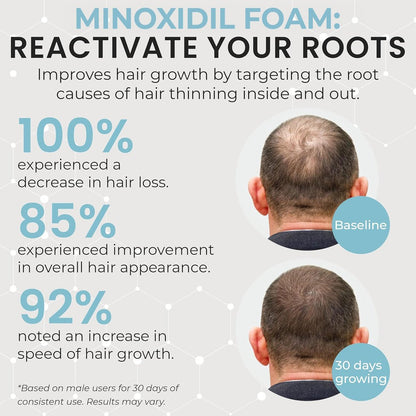 Remixidil Men's 5% Minoxidil Foam – Clinically Proven Hair Regrowth Treatment, 3-Month Supply, No Scalp Irritation Avelisse