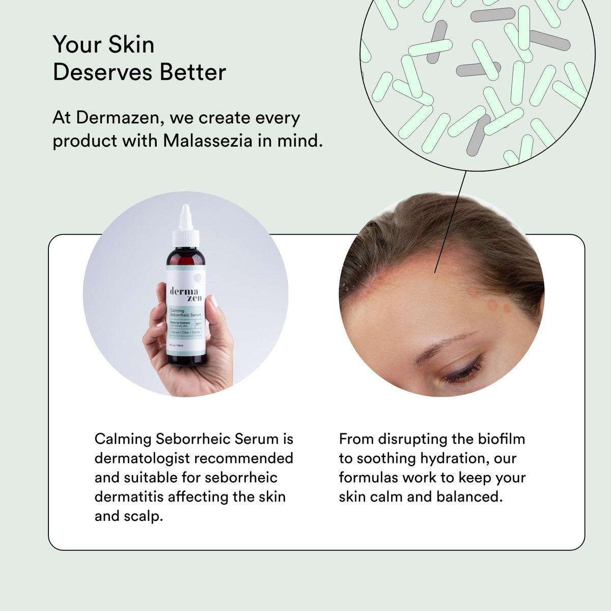 Dermazen MCT Scalp Moisturizer – Soothes Itch & Hydrates Dry, Flaky Scalp – Malassezia & Seborrheic Dermatitis-Safe – Tea Tree & Rosemary – 4 oz Avelisse