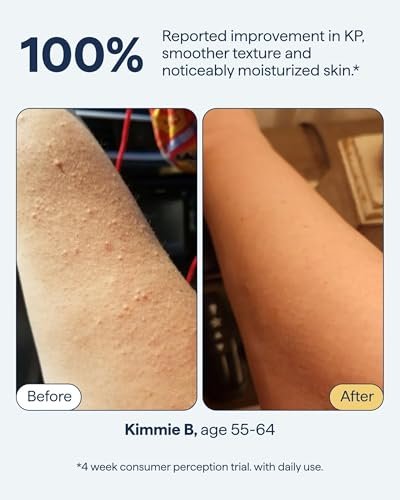 KP Exfoliating Body Moisturizer for Keratosis Pilaris & Crepey Skin | Remedy Science by Dr. Shah Avelisse