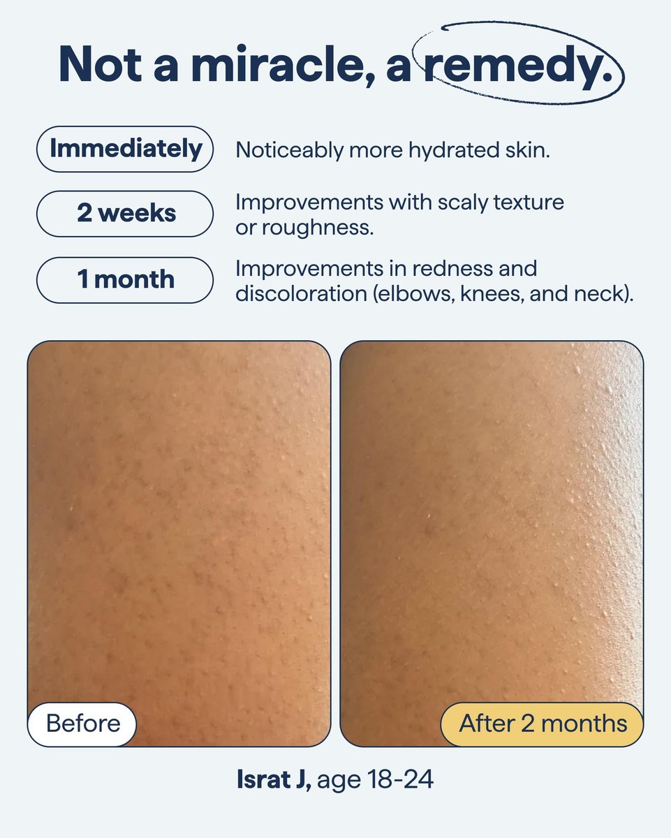 KP Exfoliating Body Moisturizer for Keratosis Pilaris & Crepey Skin | Remedy Science by Dr. Shah Avelisse