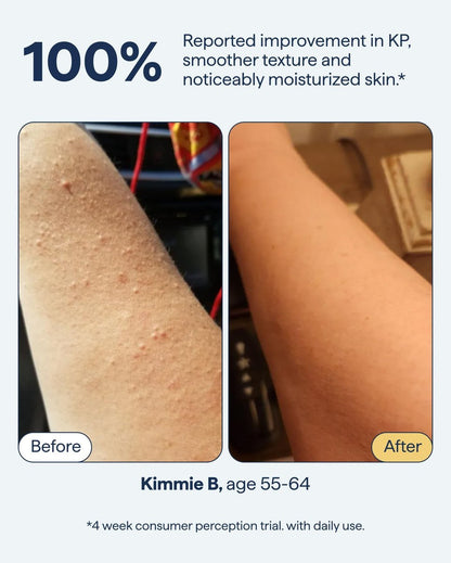 KP Exfoliating Body Moisturizer for Keratosis Pilaris & Crepey Skin | Remedy Science by Dr. Shah Avelisse