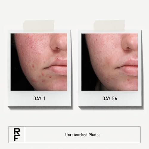 Rodan + Fields Spotless Regimen: Benzoyl Peroxide Face Wash for Sensitive Skin – Acne Skincare Set for Adults & Teens, All Skin Types Avelisse
