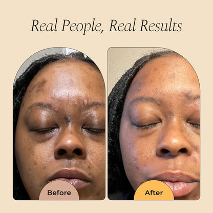 Glo Melanin Dark Spot Remover & Corrector Serum for Face with Vitamin C | Reduces Hyperpigmentation & Discoloration Avelisse