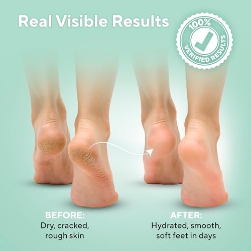 Lavinso Urea Cream 40 Percent for Feet – Maximum Strength Foot Cream for Calluses, Dry Cracked Heels & Rough Skin Repair for Men and Women - görsel 5