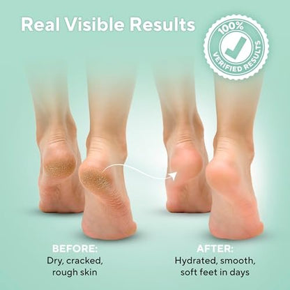 Lavinso Urea Cream 40 Percent for Feet – Maximum Strength Foot Cream for Calluses, Dry Cracked Heels & Rough Skin Repair for Men and Women