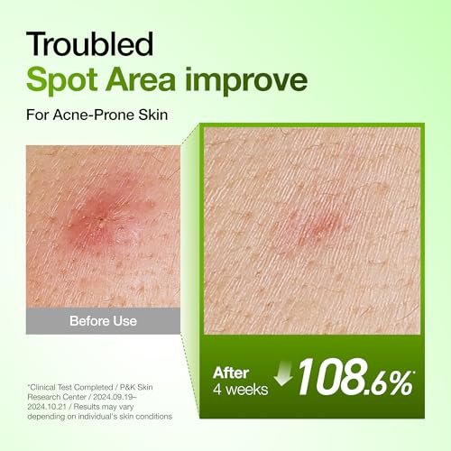 Anua Azelaic Acid 10 Hyaluron Redness Soothing Serum – Lightweight Hydrating Blemish Care for Oily & Blemish-Prone Skin, Korean Skincare, 1.01 fl oz Avelisse