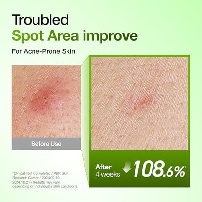 Anua Azelaic Acid 10 Hyaluron Redness Soothing Serum – Lightweight Hydrating Blemish Care for Oily & Blemish-Prone Skin, Korean Skincare, 1.01 fl oz Avelisse