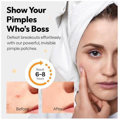 300 Pimple Patches – Hydrocolloid Zit Stickers with Salicylic Acid, Tea Tree & Calendula | Overnight Blemish Care