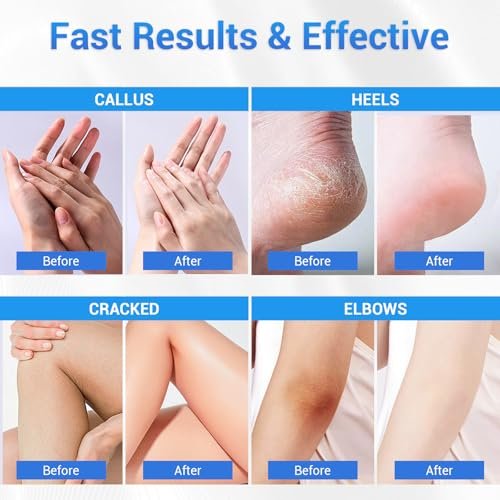 Sagry Urea Cream 40 Percent Maximum Strength for Feet, Dry Cracked Heels, Knees, Elbows, Hands - Deep Moisturizing Callus Remover & Heel Crack Repair (3.5 oz) - görsel 12