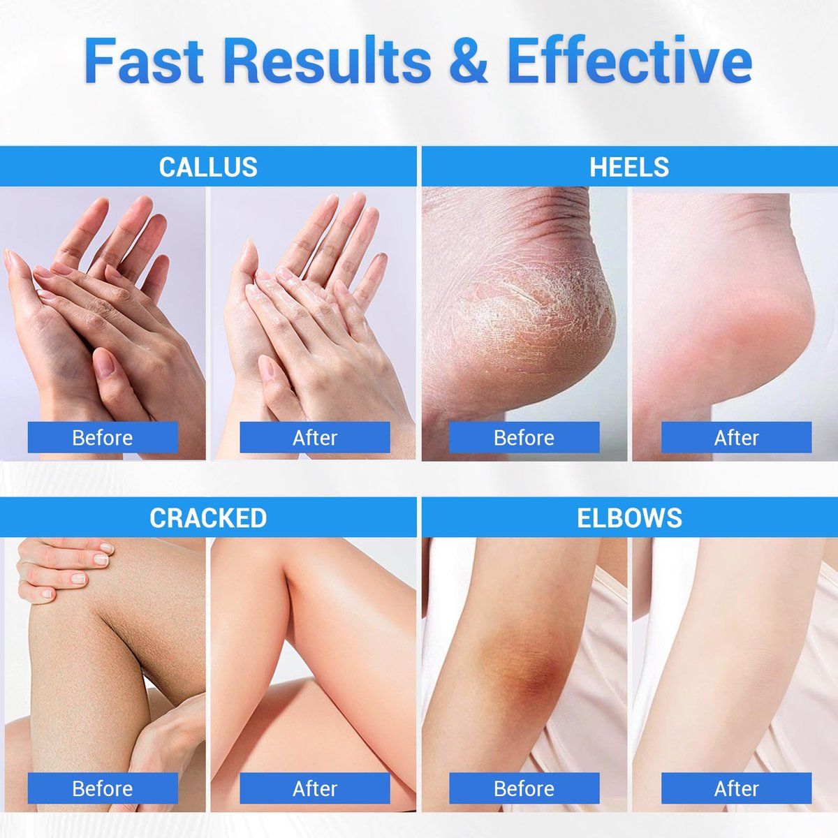 Sagry Urea Cream 40 Percent Maximum Strength for Feet, Dry Cracked Heels, Knees, Elbows, Hands - Deep Moisturizing Callus Remover & Heel Crack Repair (3.5 oz) - görsel 11