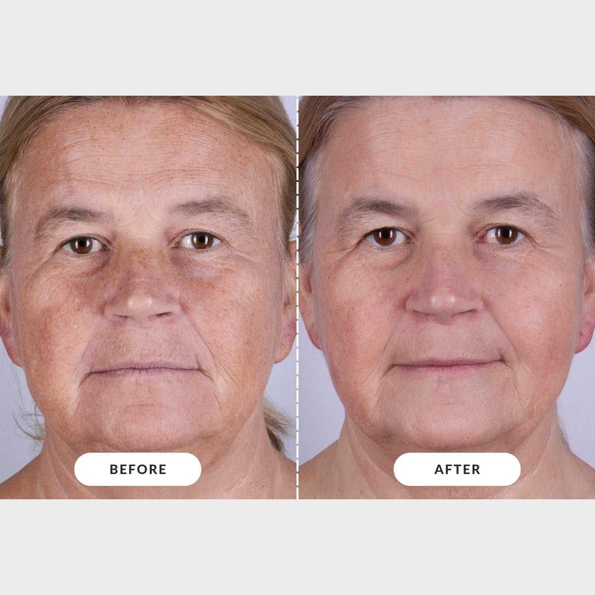 CurrentBody Skin LED Light Therapy Mask: Series 2 – Professional-Grade Anti-Aging & Acne Treatment at Home Avelisse