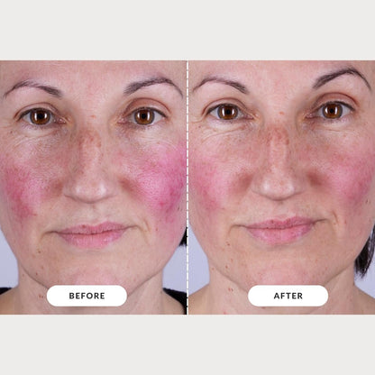 CurrentBody Skin LED Light Therapy Mask: Series 2 – Professional-Grade Anti-Aging & Acne Treatment at Home Avelisse