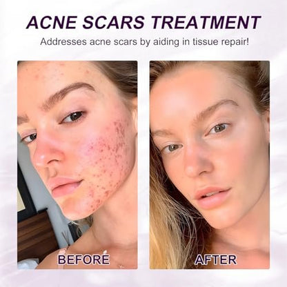Azelaic Acid 10% Serum with Niacinamide & Hyaluronic Acid - Acne Treatment, Redness Relief, Rosacea Skin Care & Radiance Booster - 1 Fl Oz Avelisse