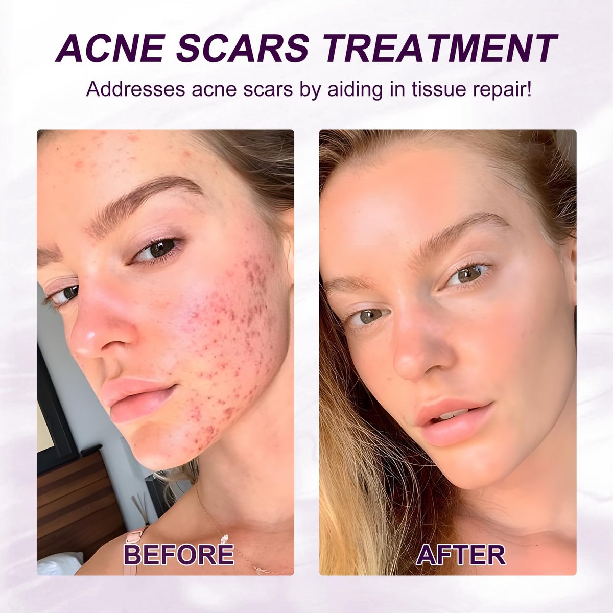 Azelaic Acid 10% Serum with Niacinamide & Hyaluronic Acid - Acne Treatment, Redness Relief, Rosacea Skin Care & Radiance Booster - 1 Fl Oz Avelisse