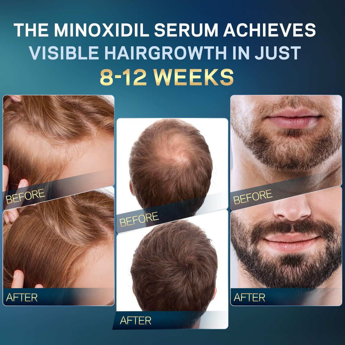 5% Minoxidil for Men and Women Hair Growth - AMOADO Hair Regrowth Serum with Rosemary & Biotin for Thicker, Fuller Hair & Beard Growth - 2 fl oz - görsel 9