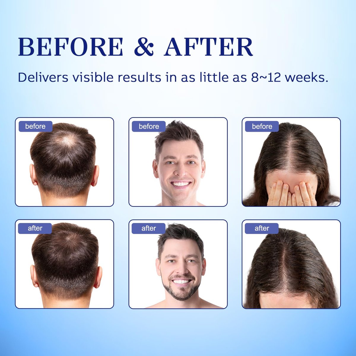 5% Minoxidil Hair Regrowth Spray for Men and Women - 2 Pack Avelisse