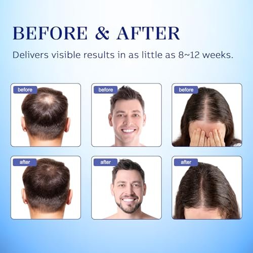 5% Minoxidil Hair Regrowth Spray for Men and Women - 2 Pack Avelisse